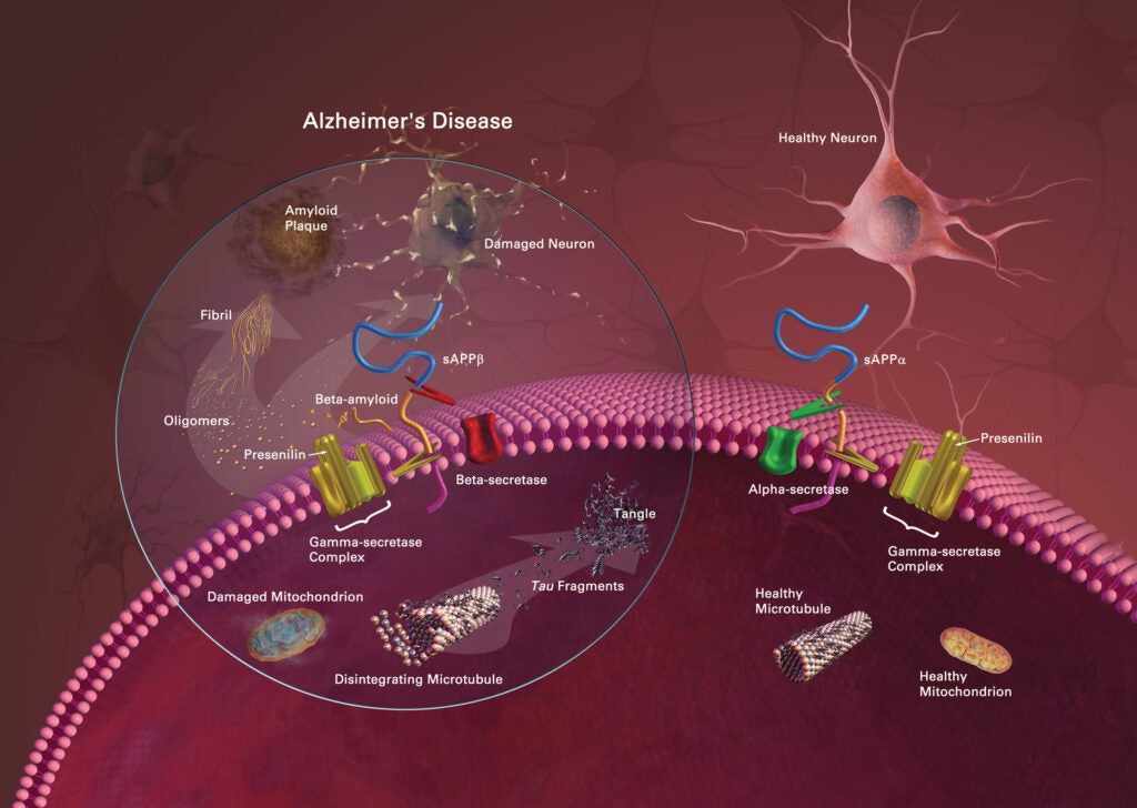 Healthy Neuron vs. Alzheimer's Neuron
