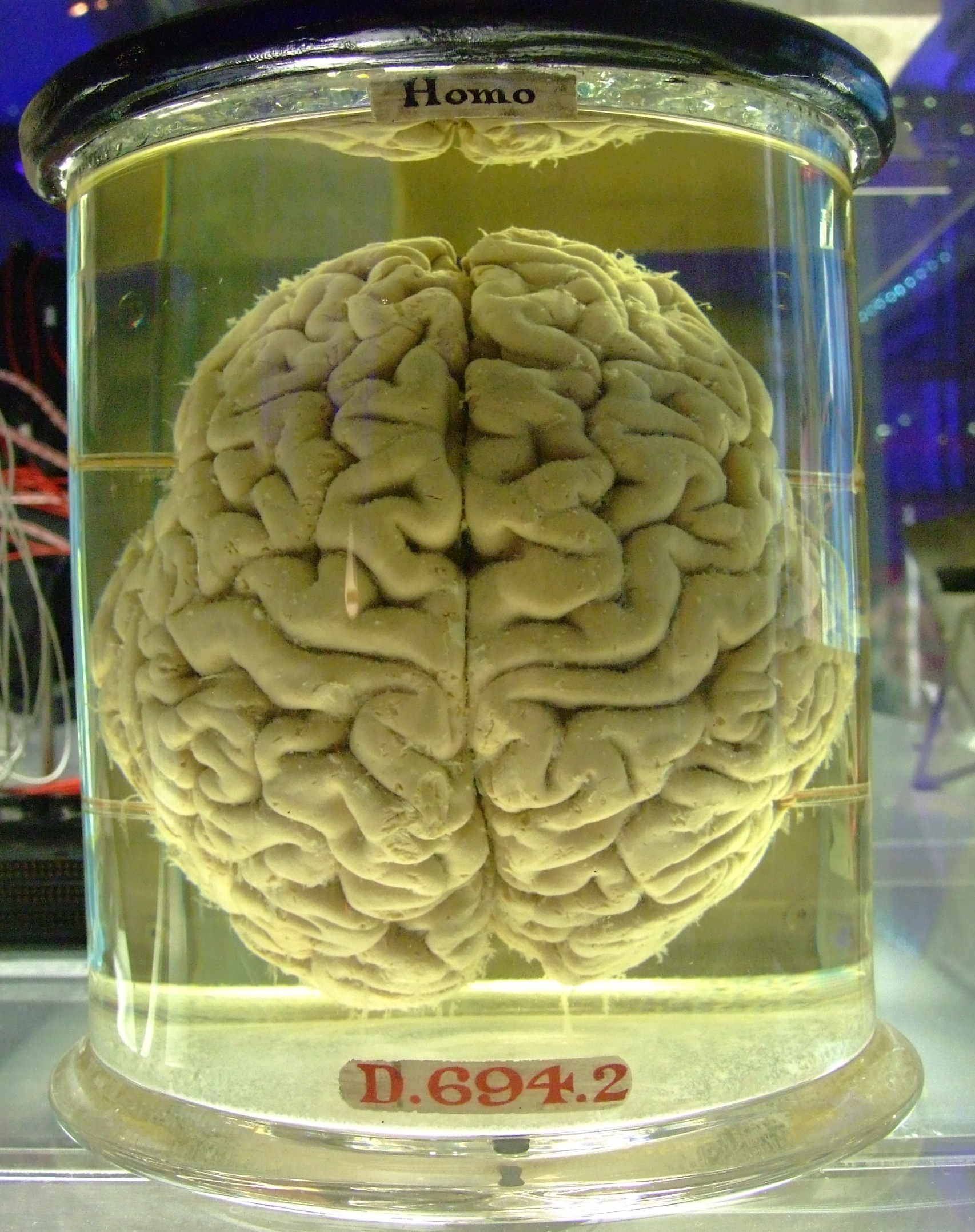 To Track Mental Illness, Researchers Are Taking the DNA Of Century-Old Brains In Jars
