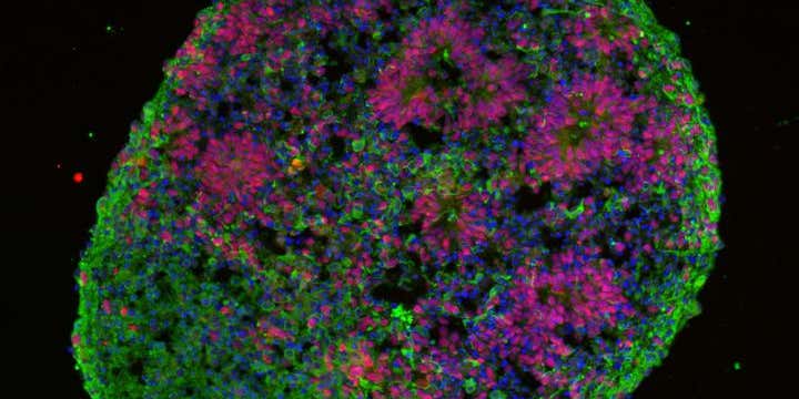 Growing Micro-Brains From Skin Cells Sheds Light On Autism