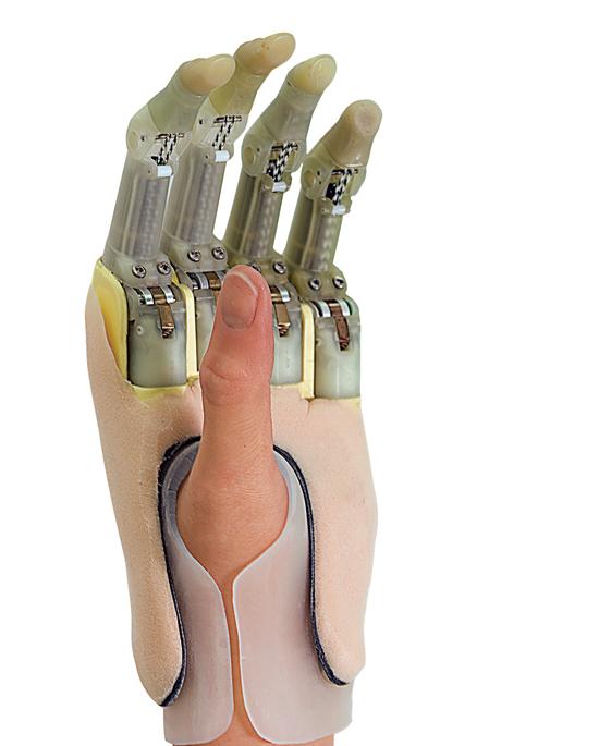 Roboticists have built five-fingered prosthetic arms that can allow wearers to toss a ball, but the options for people with partial hand amputations are limited to crude spring-loaded digits. The ProDigits prosthesis offers fully functional individual fingers and thumbs to the 9,200 Americans each year who lose one or more fingers, and could eventually help the 1,700 babies born every year in the U.S. with partial hand loss. The breakthrough is miniaturization. Most full hand prosthetics stow the electronics and batteries in the palm, but because partial amputees still have their palm, Touch Bionics engineers redesigned everything to fit on the socket. Electrodes in the socket read muscle impulses to control the fingers. Adaptive programming adds functionality: Over time, patients can graduate from making a fist to typing. $50,000-$80,000; <a href="http://www.touchbionics.com/">touchbionics.com</a> See more at the <a href="https://www.popsci.com/tags/bown-2010/">Best of What's New 2010</a> site. <strong>Jump To:</strong>