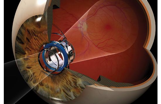 Macular degeneration, which kills the photoreceptors at the center of the retina, robs nearly a third of Americans older than 75 of their "straight-ahead" vision. With a quick outpatient procedure, this telescope eye implant restores this vision by spreading that light to healthy cells on the retina's perimeter. It takes a few days for the brain to adjust to the implant, but in clinical trials, three quarters of users saw their vision improve from "severe impairment" to "moderate impairment"a€"they could once again read, watch TV and recognize faces. $15,000; <a href="http://www.centrasight.com/">centrasight.com</a> See more at the Best of What's New 2010 site. <strong>Jump To:</strong>