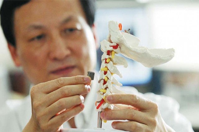 Liu Zhongiun, Director of Orthopedics at Peking University, holds the 3-D printed piece of vertebra.