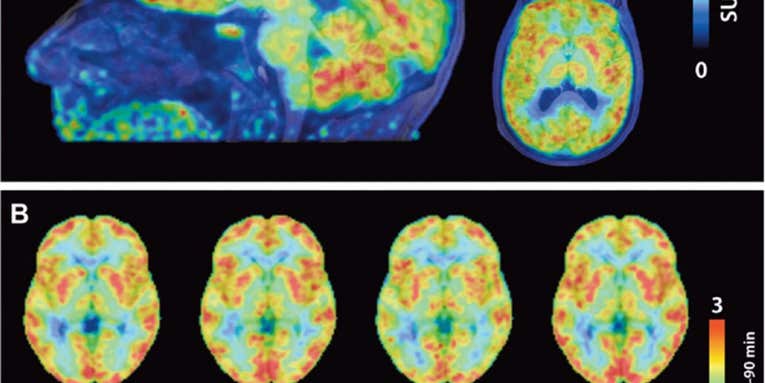 A New Type Of Brain Scan Shows Where Genes Are Being Turned Off