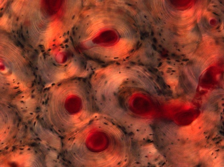 This watercolor-like image shows a part of the human thigh bone. Specifically, it shows the compact bone, which provides strength and rigidity and is solid in appearance. Shown in red are Haversian canals, part of the compact bone's intricate circulatory network. The tiny black spaces shown in this image are due to the loss of living bone cells during processing, leaving holes within the bone. [<a href="http://www.wellcomeimageawards.org">Wellcome Image Awards</a>]