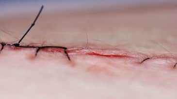 Smart Stitches Send Data As They Heal Wounds