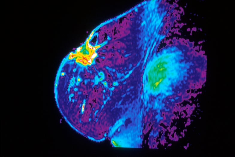 False-color MRI images like these aren't typically used for breast cancer screening, but they can provide more detailed images of the breast, which is useful for high-risk patients.