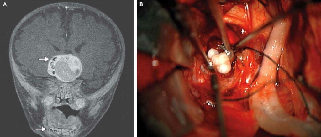 teeth found in a brain tumor