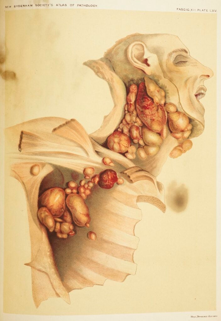 This is an early illustration, made by two English pathologists, of the cancer now called Hodgkin's lymphoma. The cancer causes cells in the lymph nodes to grow abnormally and impairs the immune system.