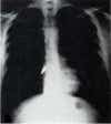 x ray of a bullet in the chest