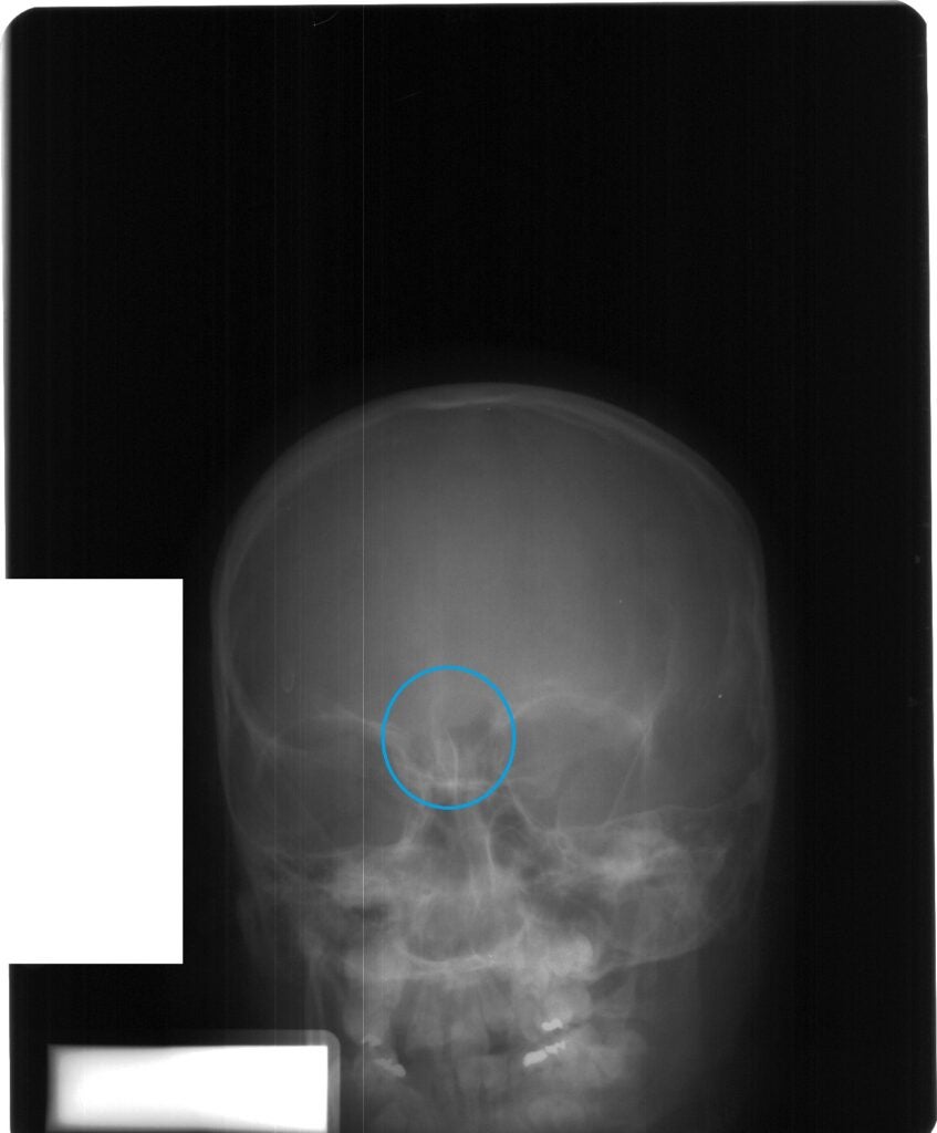 Juvenile skull showing stage two of frontal sinus development.