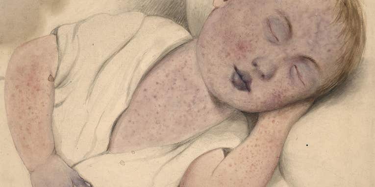 Why are the measles coming back?