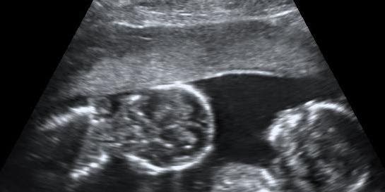 More And More Twins Are Being Born In The U.S.