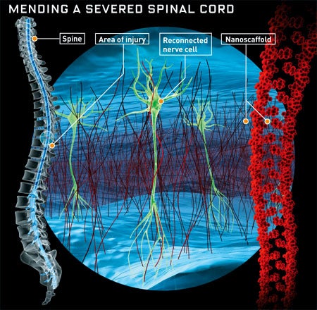 A sewing kit to stitch severed nerve cells back together <strong>The Prescription:</strong> A team of scientists has developed a technique that allows nerve cells to regrow, bridging the gaps left by injury or illness. The procedure hinges on independent strings of amino acids about one thousandth the size of a red blood cell. Because the strings have different qualities-some are positively charged, others negative, some are attracted to water, others repelled by it-they self-assemble into chain-like structures. Injected into the injured area of a patient´s brain, millions of these nanocombs would form a kind of trellis along which nerve cells could grow. With the help of other therapies, such as a drug regimen that stimulates nerve-cell growth, their axons-the long fibers that carry electrical signals-would extend through and reconnect.<br />
<strong>When?:</strong> 2010. Rutledge Ellis-Behnke of the Massachusetts Institute of Technology has tested the technique in animals. When he severed a tract in hamsters´ brains responsible for vision and added the nanothreads, he found that a striking 75 percent of the subjects regained sight. Ellis-Behnke hopes that nanoscaffolds will be used in brain surgery-healing areas injured by the surgeon´s scalpel-within five years.