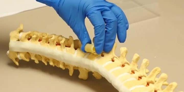 Spongy Implants Can Replace Cancerous Vertebrae