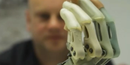Patient Elects to Have Hand Amputated to Make Way for a Bionic One