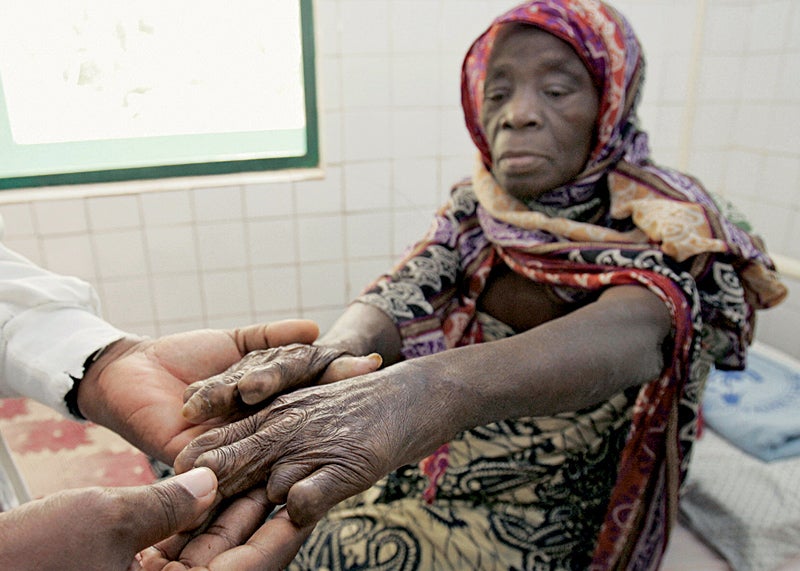 Cheaper drug discovery means better medicine for neglected diseases like leprosy, as shown here.