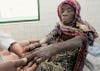 Cheaper drug discovery means better medicine for neglected diseases like leprosy, as shown here.