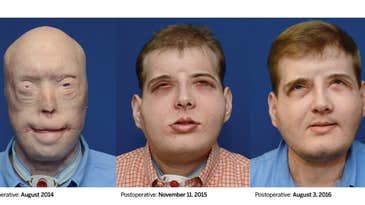 One Year Later, Face Transplant Recipient Just A Normal Guy