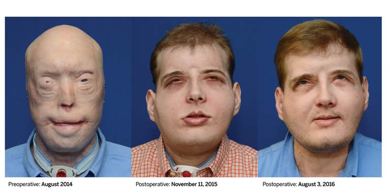 One Year Later, Face Transplant Recipient Just A Normal Guy
