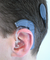 A cochlear implant typically consists of an external audio processor and transmitter, attached to the patient's head with a magnet.