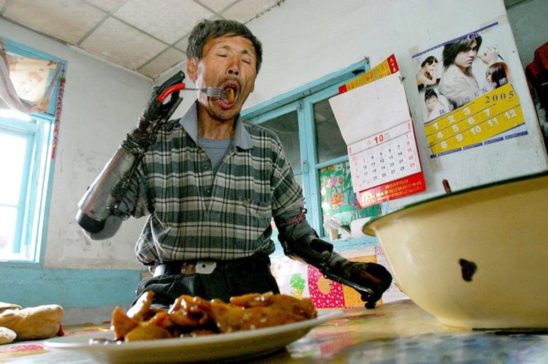 Sun Jifa, of Guanmashan, Jilin province, in northern China, lost his hands in a fishing-related explosion a decade ago. The hospital recommended him prosthetic replacements that were far too expensive. Undeterred, Sun built his own bionic arms that can actually grip and squeeze objects via a system of pulleys and wires manipulated by movements of his elbows.