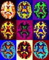 MRI Scans of brain