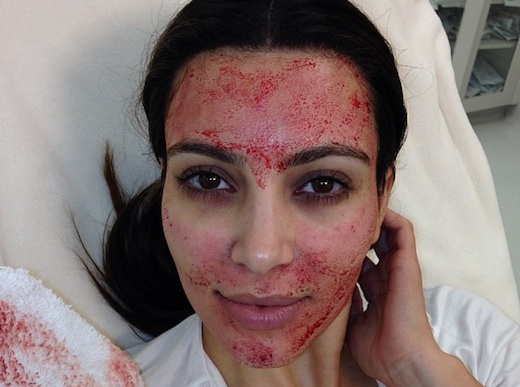 Why Are Celebrities Getting Vampire Facials?