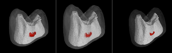 Electrical Currents Could Heal Cavities, Replace Drilling
