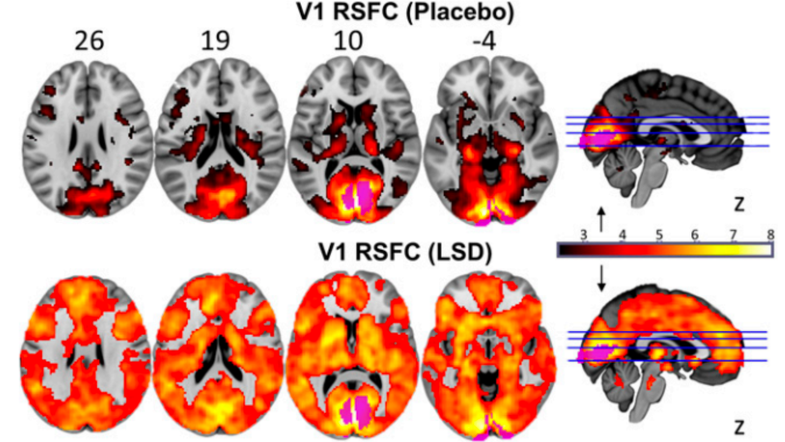 Connectivity of a brain on LSD