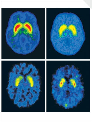 WHAT BRAIN SCANS REVEAL Clockwise, from top left: Normal brain, brain of an obese person, brain of an alcoholic, brain of a cocaine user. The brightly colored areas in these images mark the nucleus accumbens, the brain's reward center. Red indicates a high number of receptors for dopamine, a brain chemical that transmits sensations of pleasure; yellow and green indicate fewer receptors. People short on dopamine receptors have difficulty feeling joy. Many scientists have been surprised by recent studies revealing that the biochemistry of classic addictions, such as alcoholism and drug abuse, is strikingly similar to that of compulsive activities, including gambling and overeating.
