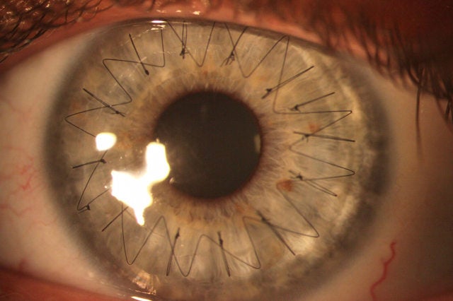 A guy on Reddit who goes by the name Philawesomeraptor took this photo of his girlfriend's eye after she received a cornea transplant. Yep, those are real stitches. [via <a href="http://www.geekologie.com/2012/07/whaaaaaaaaa-what-eyeball-stitches-look-l.php">Geekologie</a>]