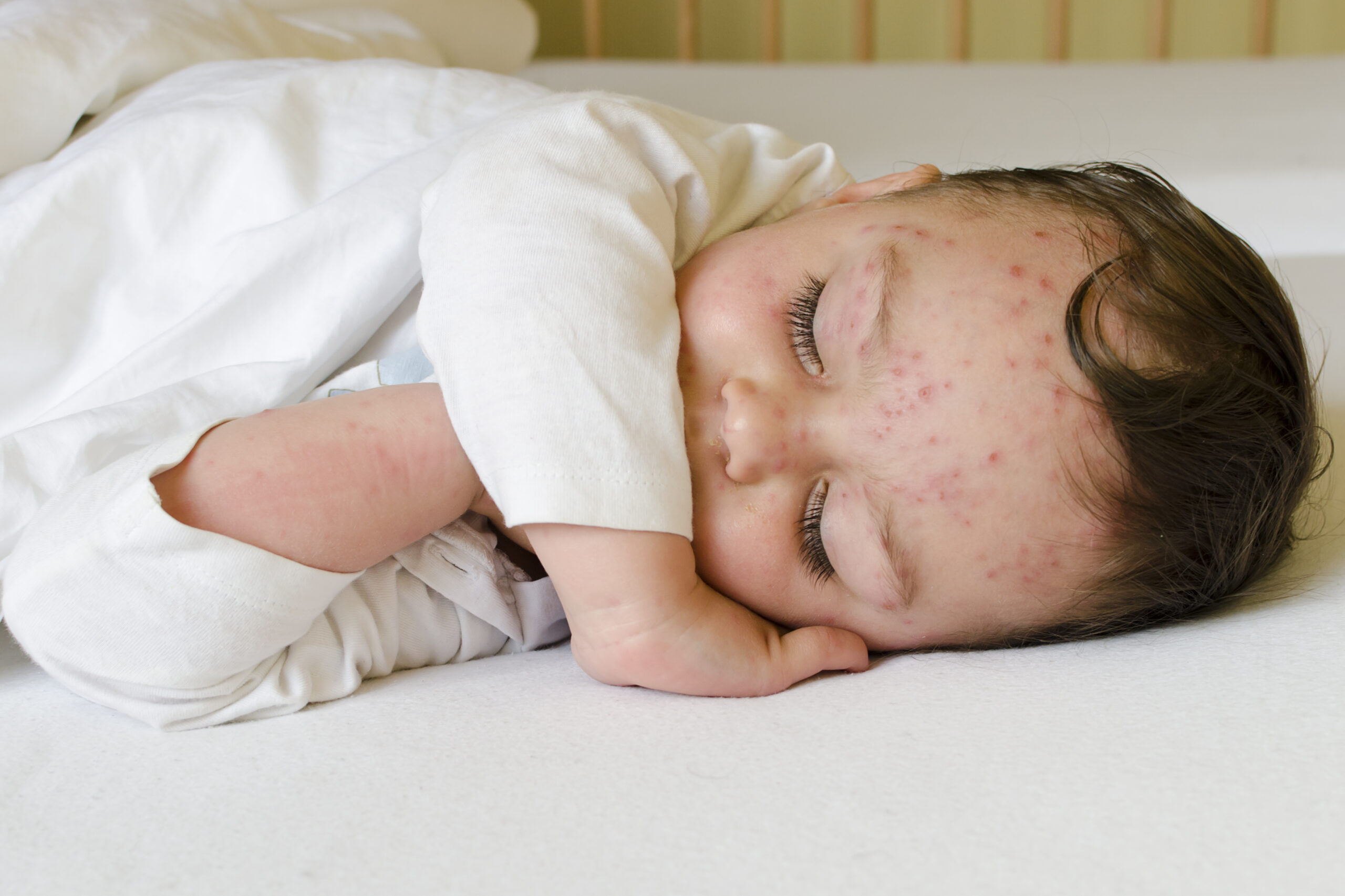 It’s not a good idea to just let your kids get chickenpox