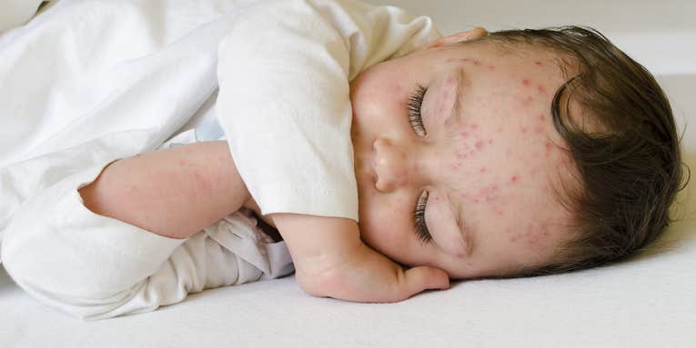 It’s not a good idea to just let your kids get chickenpox