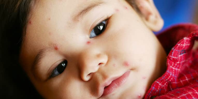 The chickenpox vaccine keeps kids safe from more than just itchy red spots
