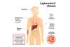 Symptoms of Legionnairesâ disease chart