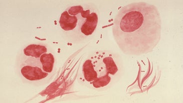Gram stain showing gonorrhea-causing bacteria
