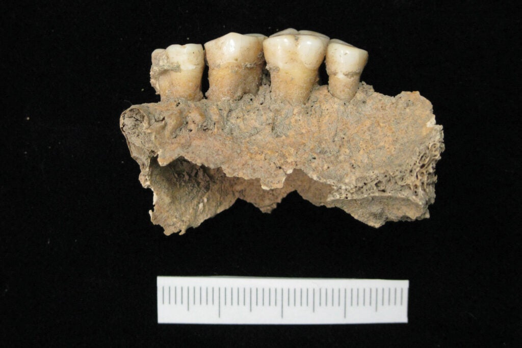 Ancient plaque on teeth