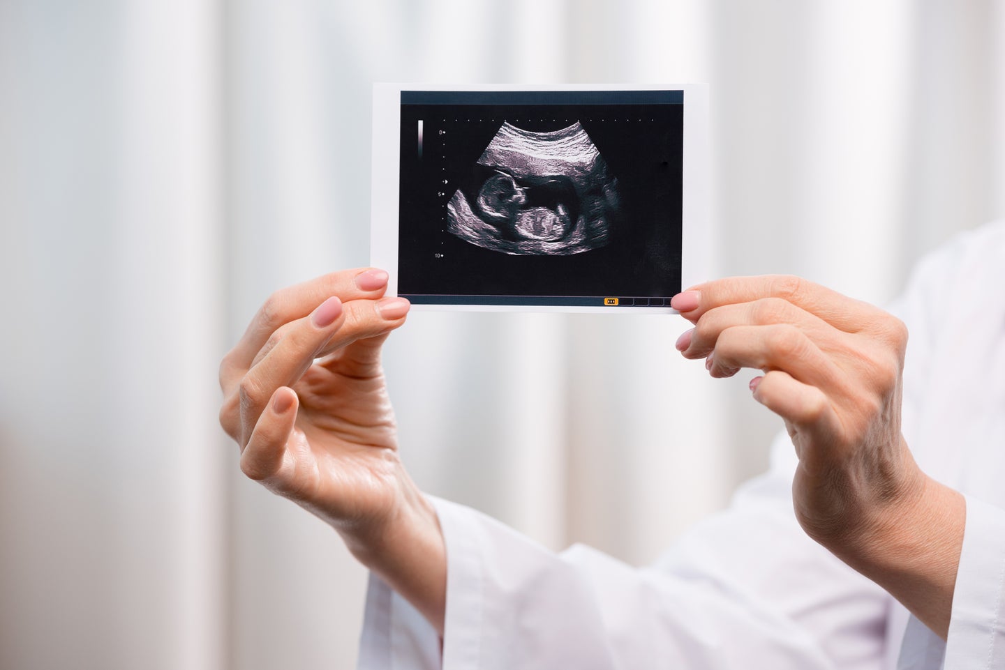 A doctor holding up a uterine ultrasound