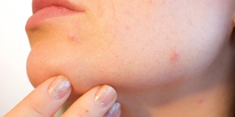 This popular acne medication carries a disturbing legacy