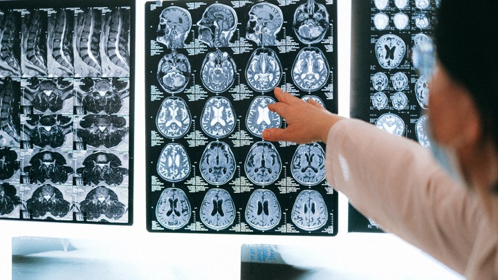 Doctor examines MRI brain scans.