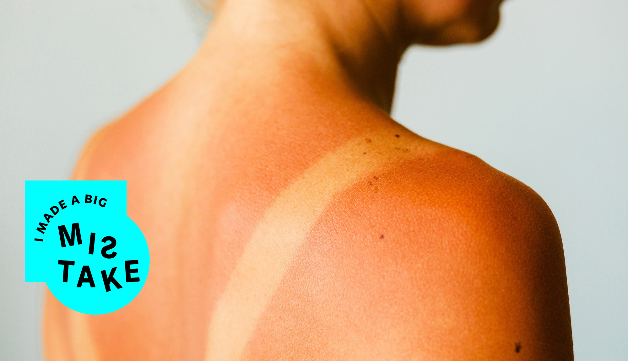 a person showing a sunburn on their shoulder and back, probably looking for a sunburn treatment.