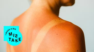 A sunburn treatment that actually works
