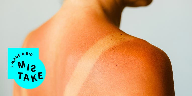 A sunburn treatment that actually works