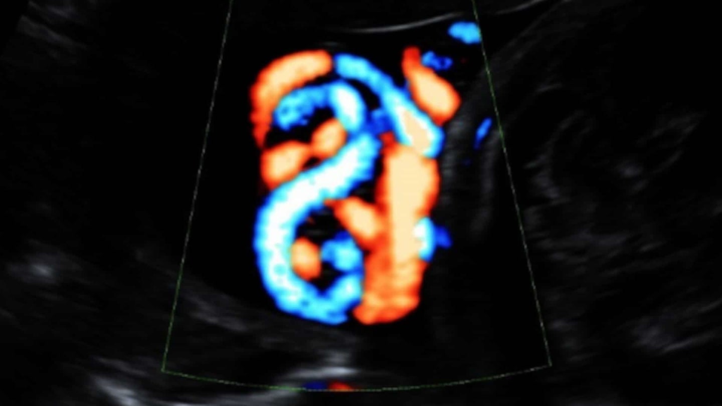 Umbilical cord knot seen on screening images