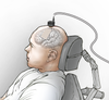 Illustration showing placement of the eCOG electrode on the participantâs speech motor cortex and the head stages used to connect the electrode to the computer. 