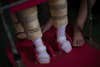 Baby with Zika congenital syndrome walking with pink leg braces