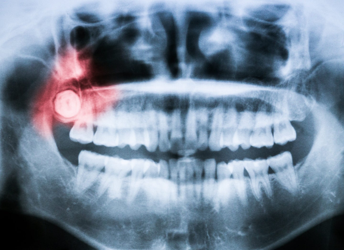 x-ray of impacted wisdom tooth
