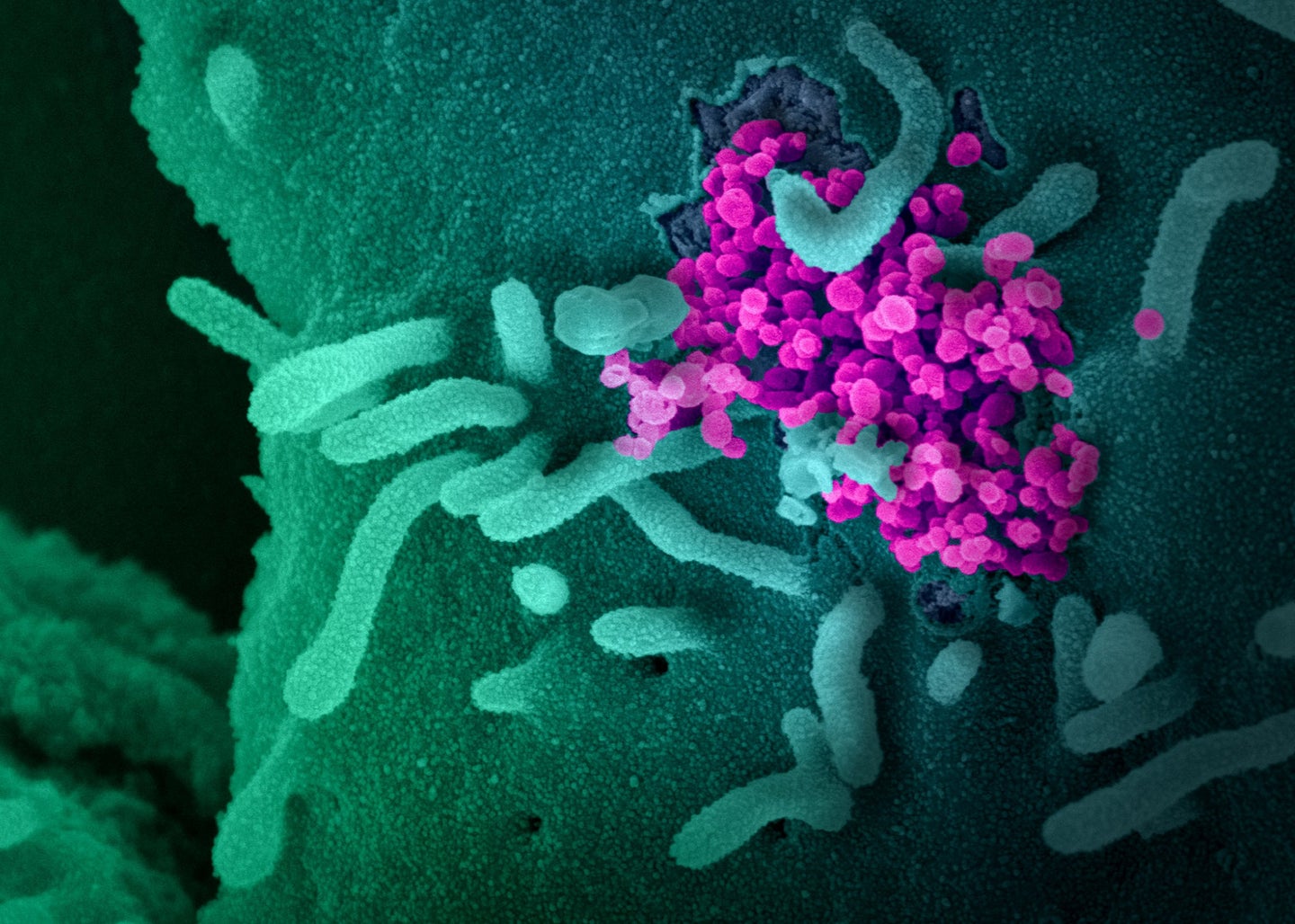 SARS-CoV-2 or COVID virus infecting human cells in a green and purple microscopy image