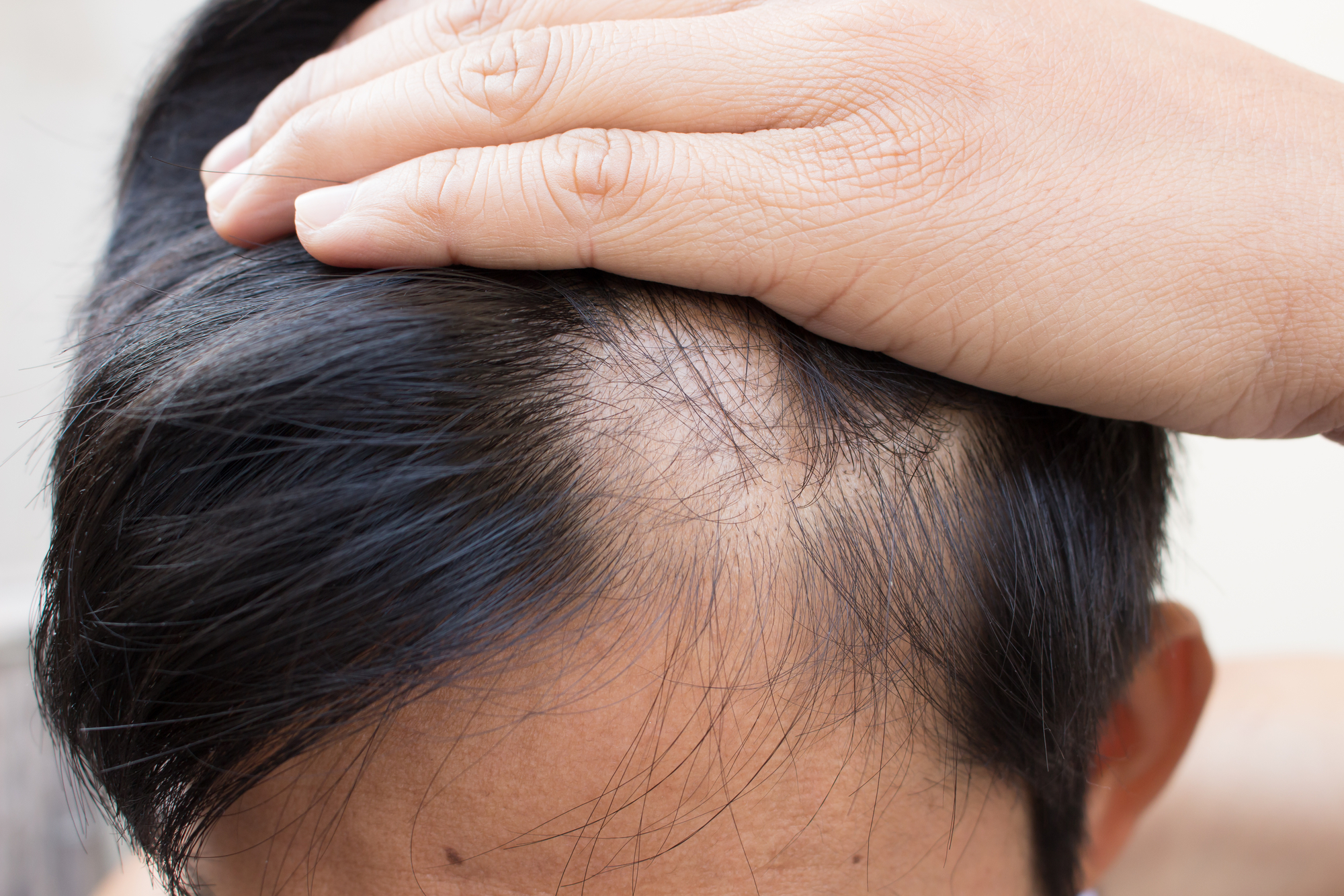 Alopecia patients finally have an FDA-approved hair-loss treatment