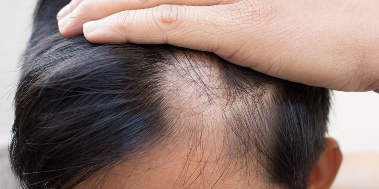 Alopecia patients finally have an FDA-approved hair-loss treatment